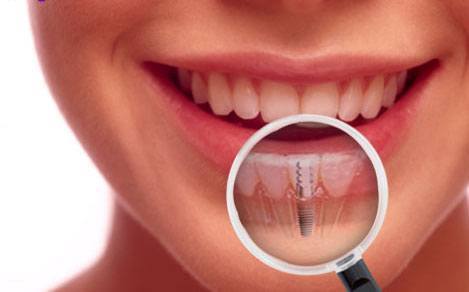 Zahnimplantate in Ungarn bei Moritz Dental Zentrum