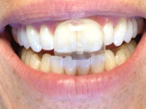 Bruxismus führt zur Abnuztung der Zähne